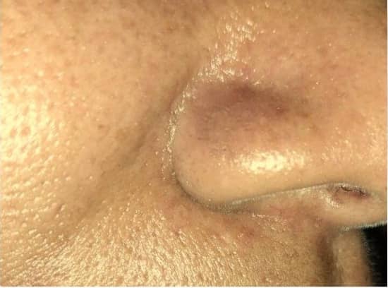 After — Cheek Mole Removal