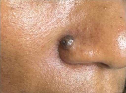 Before — Cheek Mole Removal
