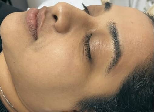 After — Facial Laser Hair Removal