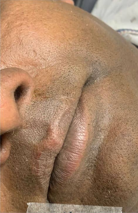 After — Cheek Mole Removal