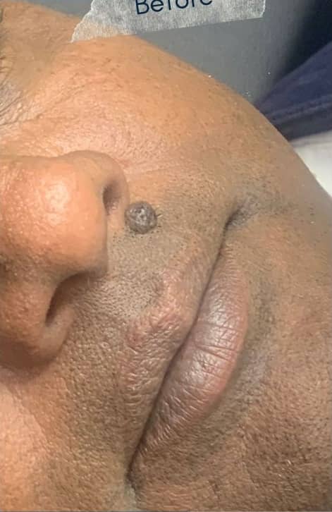Before — Cheek Mole Removal