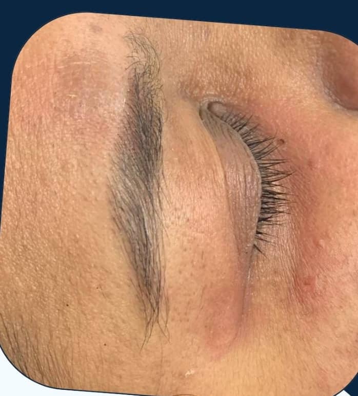After — Mole & Skin Tag Removal