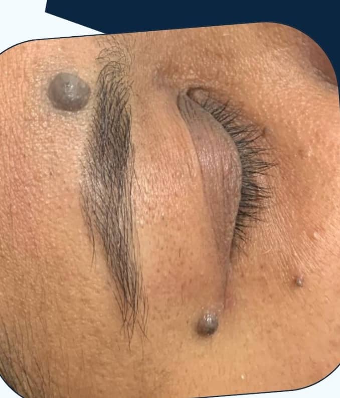 Before — Mole & Skin Tag Removal