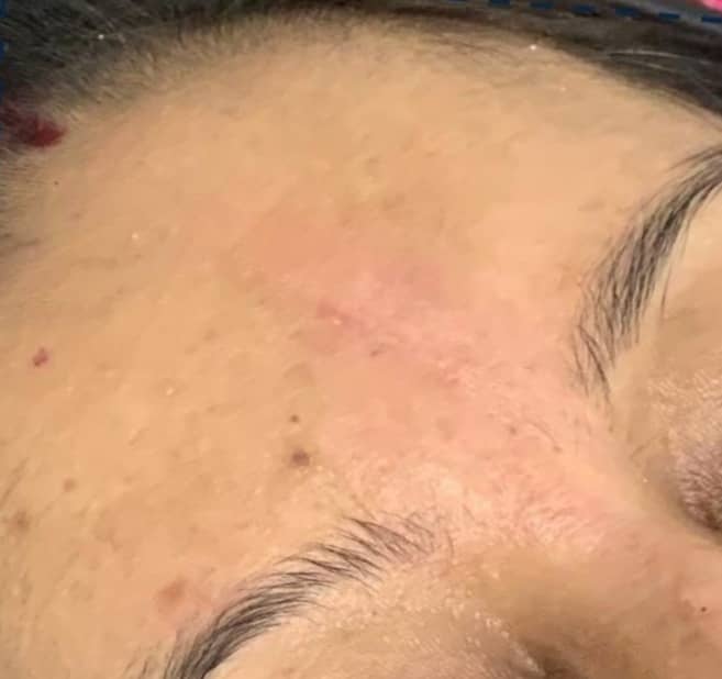 After — Forehead Mole Removal