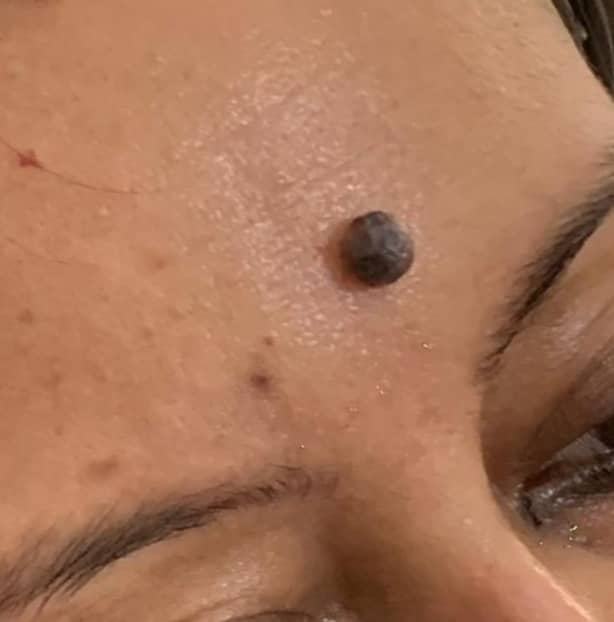 Before — Forehead Mole Removal