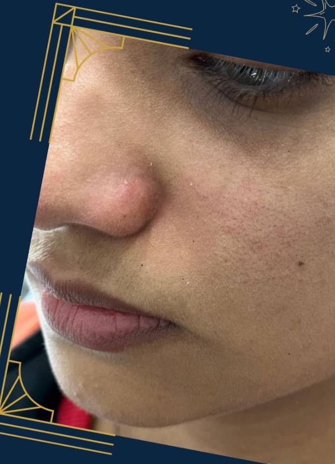 After — Nose Mole Removal
