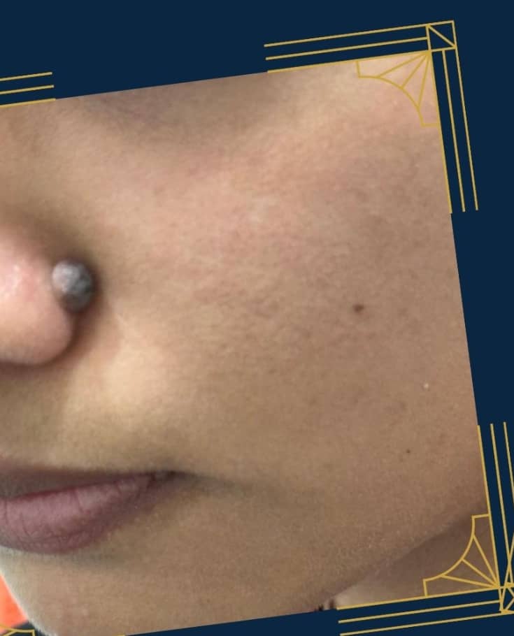 Before — Nose Mole Removal