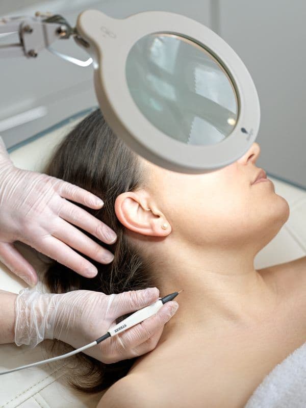 Electrolysis treatment at Diamond Laser Centre Mauritius