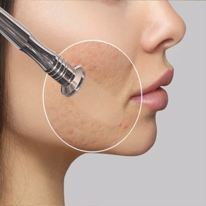 Microdermabrasion treatment at Diamond Laser Centre Mauritius