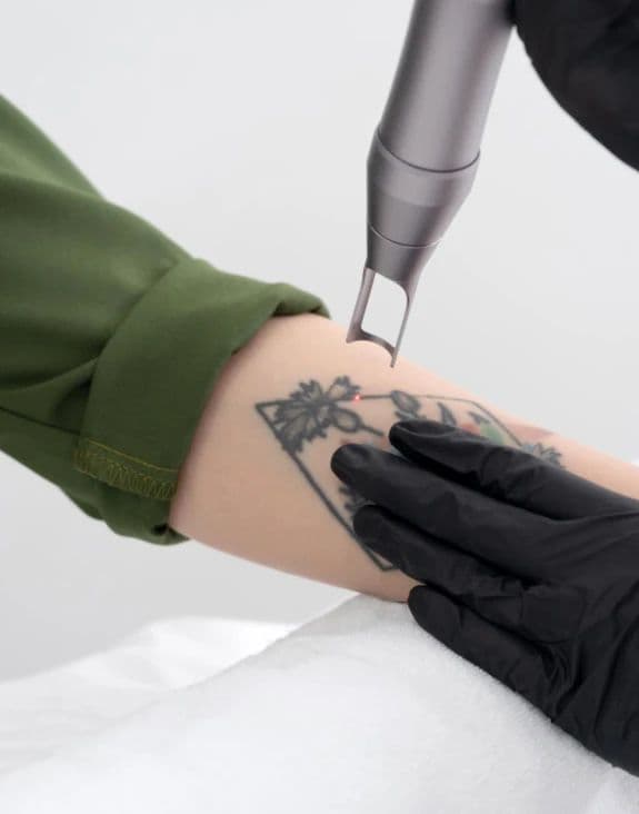 Tattoo Removal